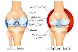 آرتروز مفاصل